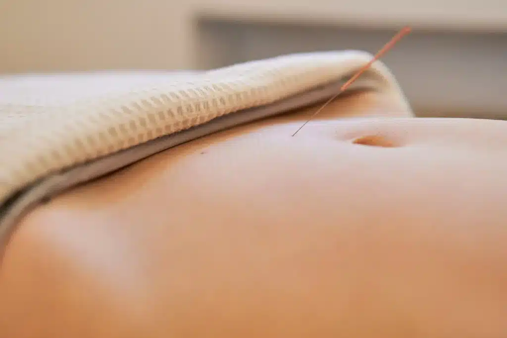 Considerando la acupuntura y el éxito de la FIV en un viaje de fertilidad