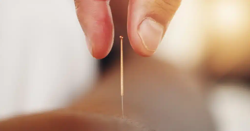 Paulus Protocol acupuncture used during IVF transfer